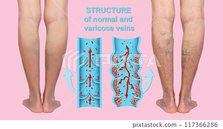 Varicose veins on a female senior legs. The structure of normal and varicose veins. Varicose veins on a female senior legs. The structure of normal and varicose veins. 117366286