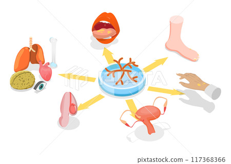 3D Isometric Flat  Illustration of Candidiasis, Medical Infographics 117368366