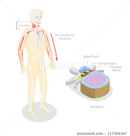 3D Isometric Flat  Illustration of Cervical Radiulopathy, Traumatic Spinal Cord Injury with Painful Pinched Nerves 117368367