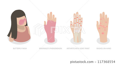 3D Isometric Flat  Illustration of Systemic Lupus Erythematosus, Butterfly Rash Red Patches 117368554