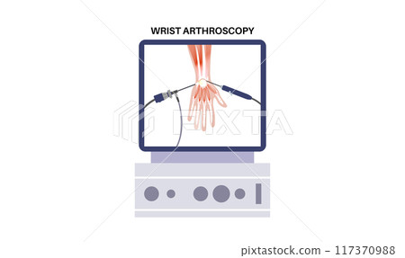 Wrist arthroscopy surgery Wrist arthroscopy surgery 117370988