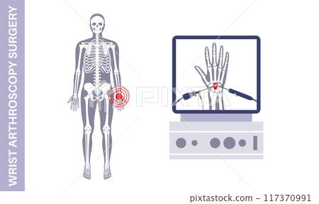 Wrist arthroscopy surgery 117370991