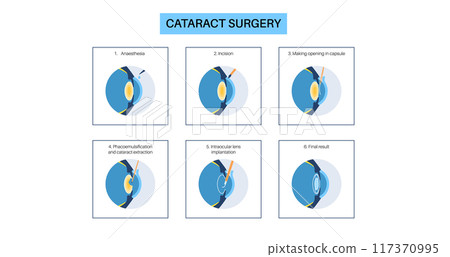 Cataract surgery poster 117370995