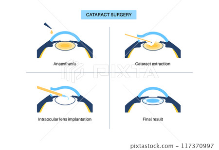 Cataract surgery poster 117370997