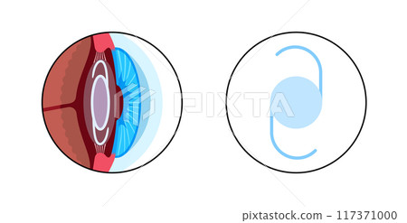 Intraocular lens poster 117371000