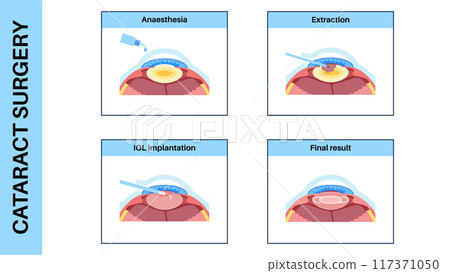 Cataract surgery poster 117371050