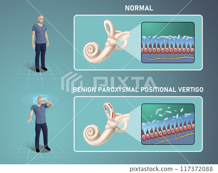 Benign paroxysmal positional vertigo 117372088
