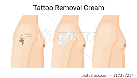 Effective Tattoo Removal Cream for Clear Skin Vector Illustration Effective Tattoo Removal Cream for Clear Skin Vector Illustration 117387254