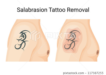 Salabrasion Tattoo Removal, Traditional Non-Laser Method Salabrasion Tattoo Removal, Traditional Non-Laser Method 117387255