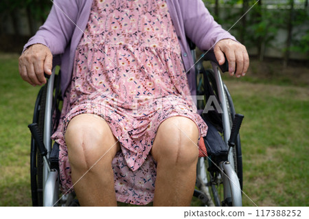 Asian elderly woman patient show her scars surgical total knee joint replacement Suture wound surgery arthroplasty on bed in nursing hospital ward, healthy strong medical concept. 117388252