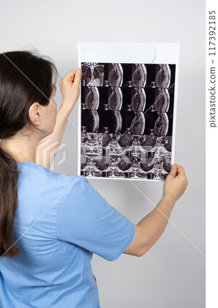 The doctor holds an MRI image of a patient with intervertebral disc protrusion and osteoarthritis of the thoracic spine. The doctor holds an MRI image of a patient with intervertebral disc protrusion and osteoarthritis of the thoracic spine. 117392185