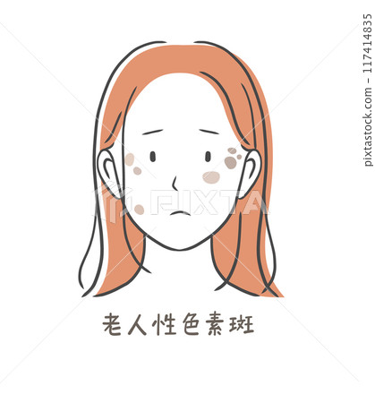 Illustration material of a woman suffering from age spots (senile lentigo) 117414835