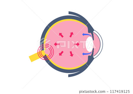 Glaucoma eye pressure Glaucoma eye pressure 117419125