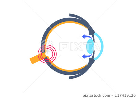 Glaucoma eye pressure 117419126