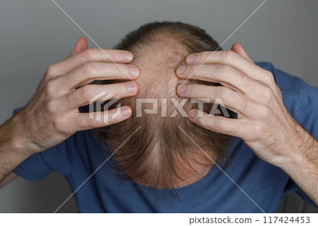 Mature balding man, close-up of top of head Mature balding man, close-up of top of head 117424453