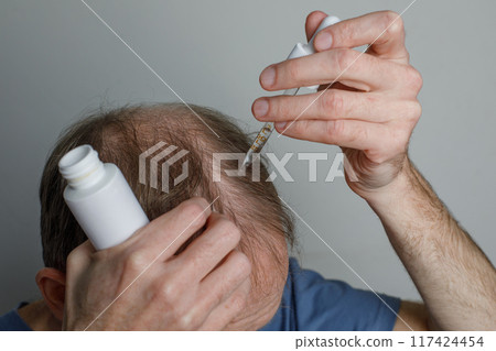 Male using hair serum or minoxidil or hair oil for the treatment of hair loss Male using hair serum or minoxidil or hair oil for the treatment of hair loss 117424454