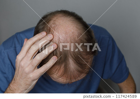 Mature male head with thin hair on his top head close-up. Hairloss and alopecia concept. 117424589