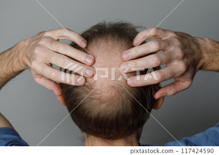 Baldness men's head with thin hair on his top head close up. Hairloss and alopecia concept. Baldness men's head with thin hair on his top head close up. Hairloss and alopecia concept. 117424590