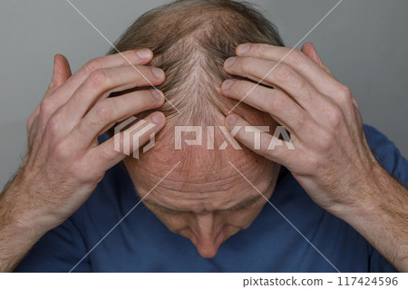 Balding man, rear view, close-up of top of head 117424596