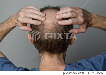 Balding man showing his head with thin hair on his bald top head. Hairloss and alopecia concept. Balding man showing his head with thin hair on his bald top head. Hairloss and alopecia concept. 117424597