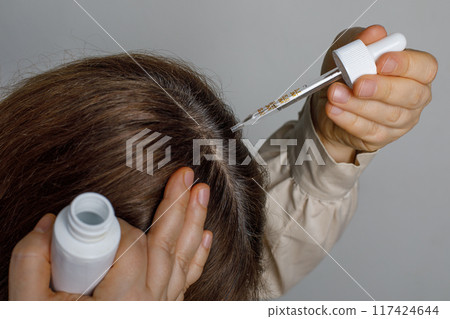 Hair loss person with serum peptide or minoxidil. Balding woman head close-up. Hair loss person with serum peptide or minoxidil. Balding woman head close-up. 117424644