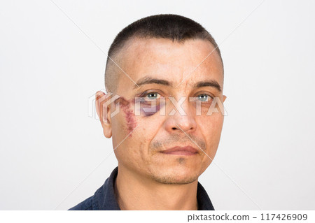Man with a black eye, hooligan criminal after a fight with a bruise and a bruise under the eye 117426909