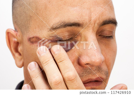 Man with a black eye, hooligan criminal after a fight with a bruise and a bruise under the eye 117426910