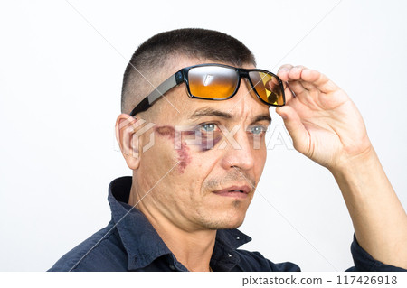 Man with a black eye, hooligan criminal after a fight with a bruise and a bruise under the eye 117426918
