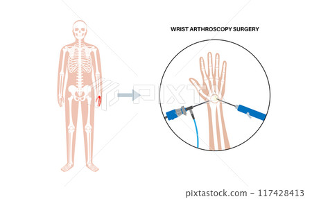 Wrist arthroscopy surgery 117428413