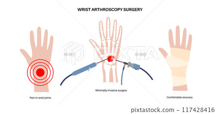 Wrist arthroscopy surgery 117428416