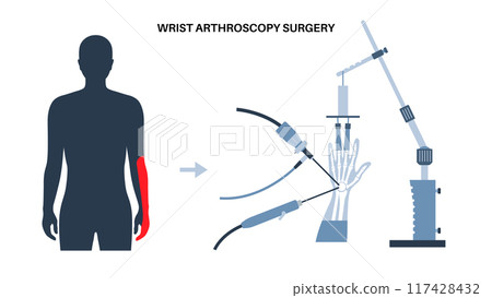 Wrist arthroscopy surgery Wrist arthroscopy surgery 117428432