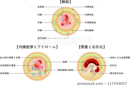 血管閉塞粥樣斑塊插圖日語 血管閉塞粥樣斑塊插圖日語 117439057