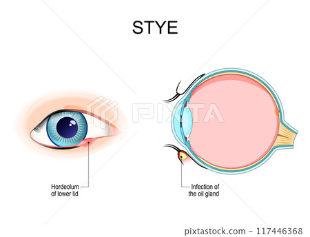 Stye. Hordeolum. Cross section of a humans eyeball with Infection 117446368