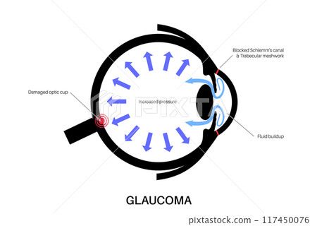 Glaucoma eye pressure 117450076