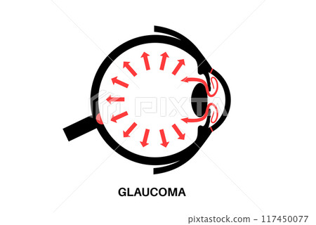 Glaucoma eye pressure 117450077