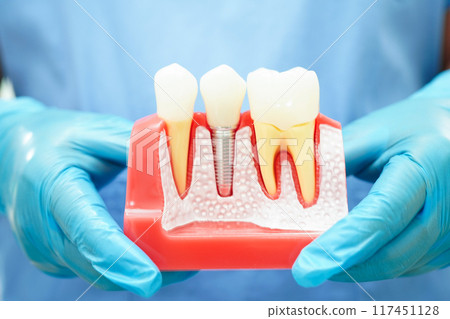 Doctor hold dental implant, artificial tooth roots into jaw, root canal of dental treatment, gum disease, teeth model for dentist studying about dentistry. Doctor hold dental implant, artificial tooth roots into jaw, root canal of dental treatment, gum disease, teeth model for dentist studying about dentistry. 117451128