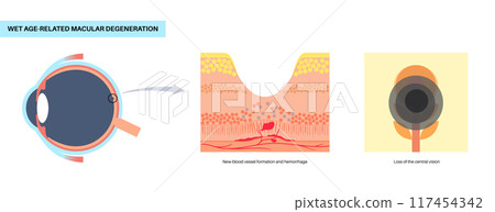 Macular degeneration poster 117454342