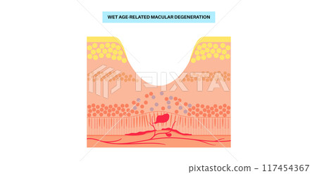 Macular degeneration poster Macular degeneration poster 117454367