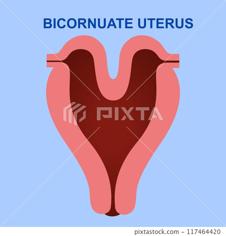 Bicornuate uterus is a congenital malformation that occurs when the uterus divides into two parts Bicornuate uterus is a congenital malformation that occurs when the uterus divides into two parts 117464420
