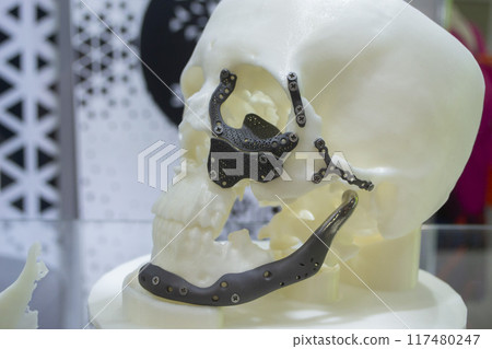 Prototype of human skull from white plastic with titanium implants in form of plates and surgical templates printed on 3D printer. Biointegrated prosthesis. Medicine medical 117480247