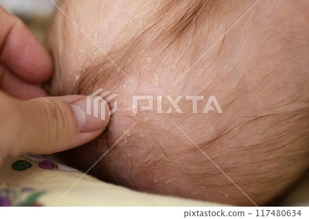 Womans hand touching pieces of dry skin on the head of a baby. Seborrheic dermatitis. Womans hand touching pieces of dry skin on the head of a baby. Seborrheic dermatitis. 117480634