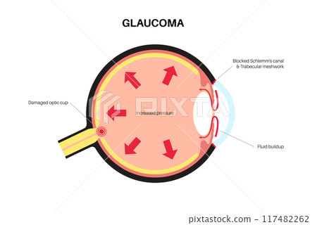 Glaucoma eye pressure 117482262