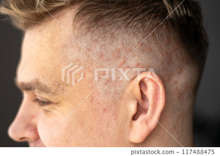 Psoriasis on the skin close-up, scalp, photos of dermatitis and eczema, skin problems concept, dermatology banner 117488475