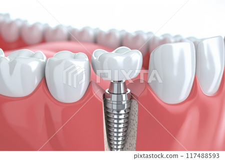 The concept of dental implants. A 3D rendering showing a dental implant placed between teeth The concept of dental implants. A 3D rendering showing a dental implant placed between teeth 117488593