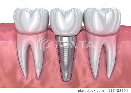The concept of dental implants. A 3D rendering showing a dental implant placed between teeth The concept of dental implants. A 3D rendering showing a dental implant placed between teeth 117488594