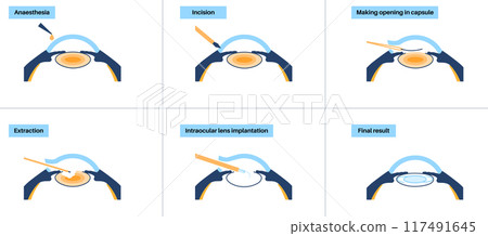 Cataract surgery poster Cataract surgery poster 117491645