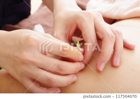 一名婦女在針灸診所接受背部針灸治療 一名婦女在針灸診所接受背部針灸治療 117504070