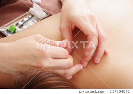 一名婦女在針灸診所接受背部針灸治療 117504072