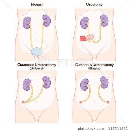 Urinary stoma, stoma, urostomy, ostomate, illustration 117511351