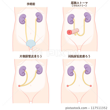 Urinary stoma, stoma, urostomy, ostomate, illustration Urinary stoma, stoma, urostomy, ostomate, illustration 117511352